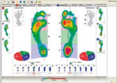 Différents appuis visualisés sur le podoscope