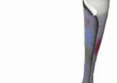 Releveur de pied en plastique thermoformé sur-mesure d'après moulage